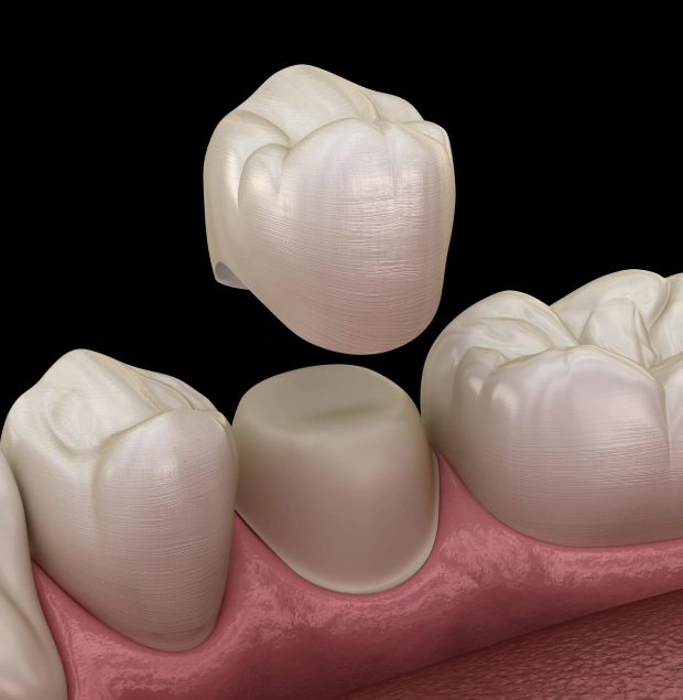 Dental Crowns