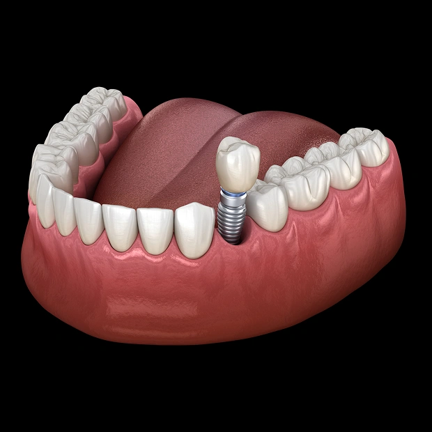 Dental Implants