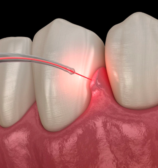 Laser Frenum Removal