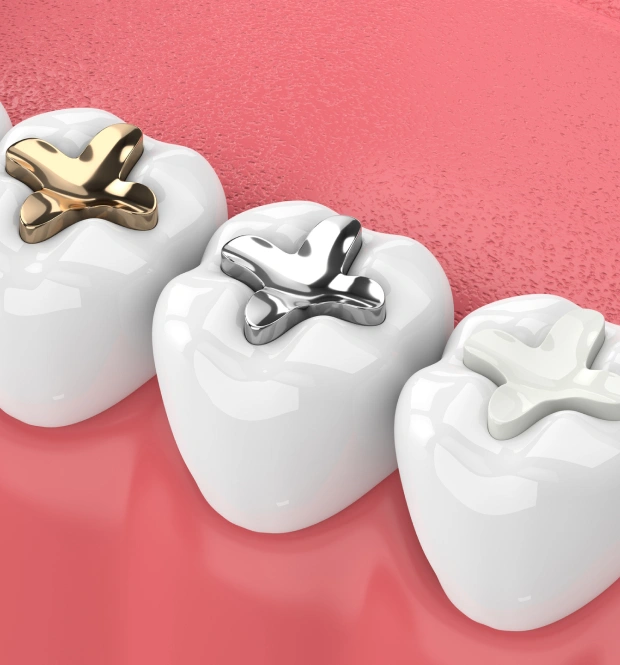 Tooth-Colored Fillings