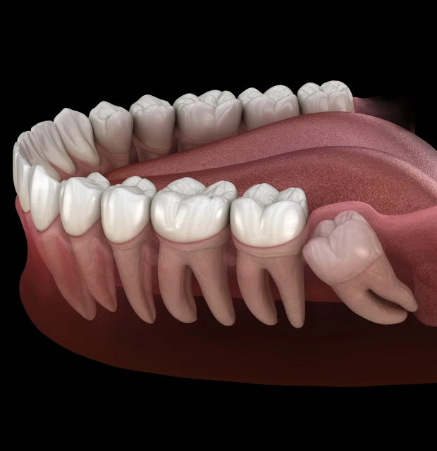 Wisdom Teeth Extractions